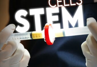 Terapia con cellule staminali del tessuto connettivo