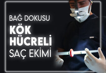 Kök Hücreli Saç Ekimi – Murat Makascı Klinik